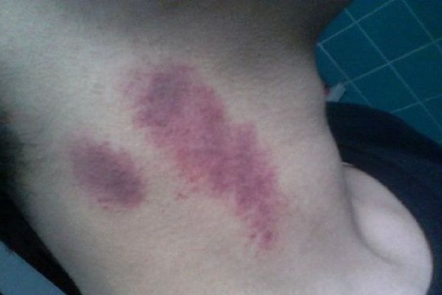 Un joven de 17 años murió luego de que le hicieran un "chupón" en el cuello